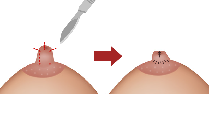 デザイン縮小法