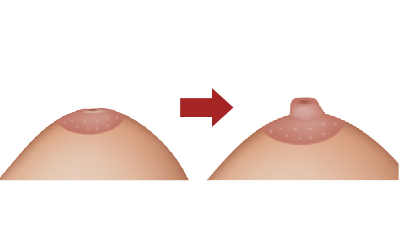 陥没乳頭手術