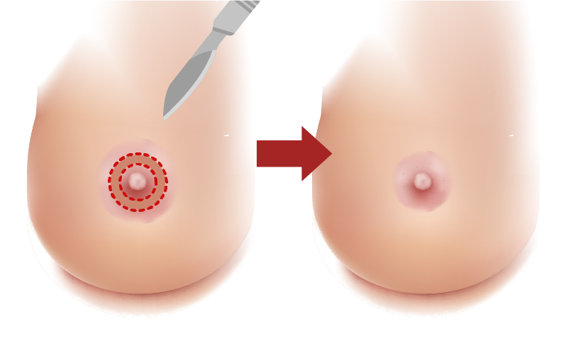 乳輪縮小術