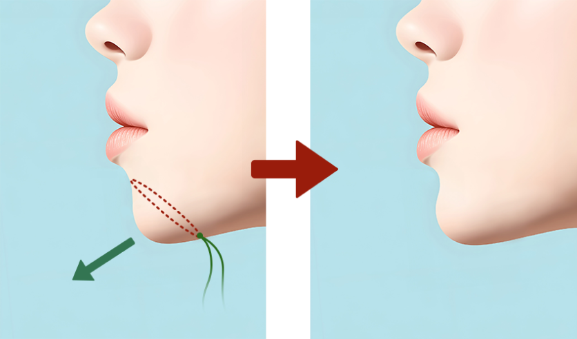 あご形成術：埋没法